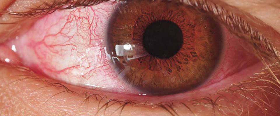 90% of smokers are unaware of the link between smoking and blindness